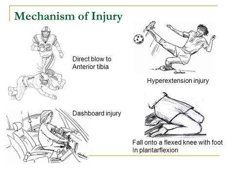 pcl tear mechanism of injury